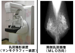 乳房撮影検査（マンモグラフィー検査）